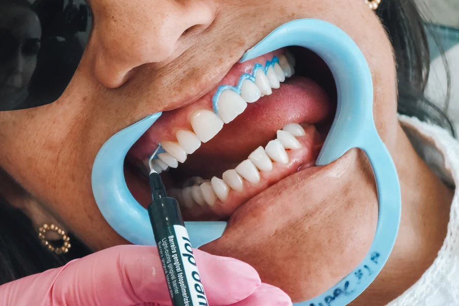 Escala de cor aplicada aos dentes durante avaliação estética